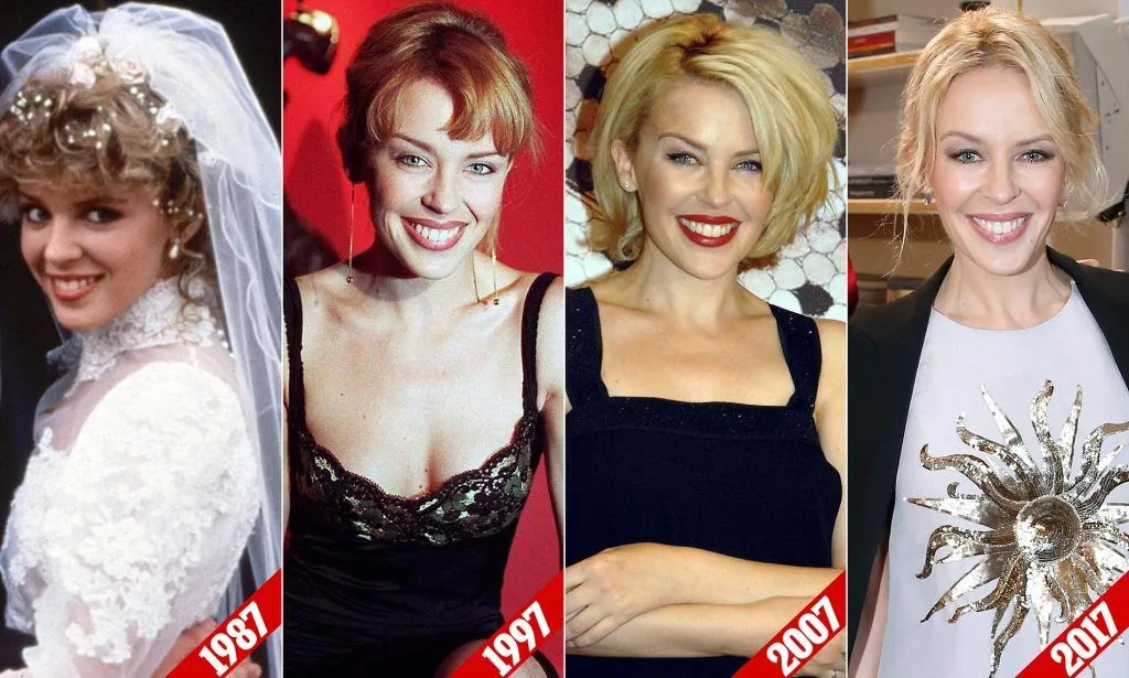 Kylie Minogue before and after fillers
