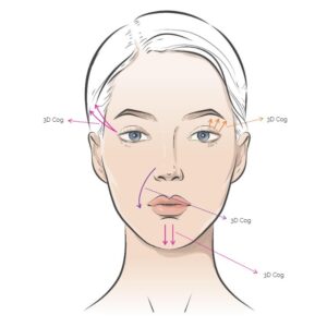 Rainbow Threads Rainbow 3D Cog 4x draadlift dermal filler oreon life science explanation 2