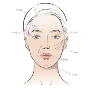 Rainbow Threads Rainbow 5G Cog 4x draadlift dermal filler oreon life science explanation 2