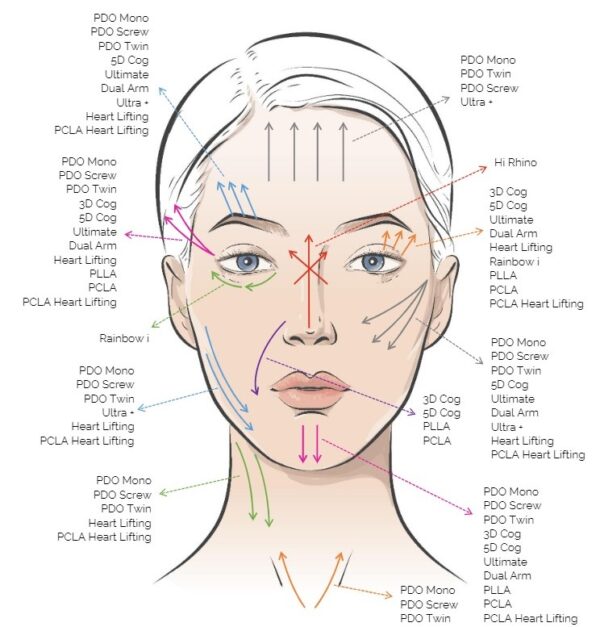 Rainbow Threads Rainbow 4x draadlift dermal filler oreon life science explanation